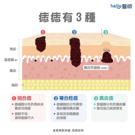 雞雞痣很多|痣形成的原因？痣長毛、痣變多變大是痣病變？5招判別